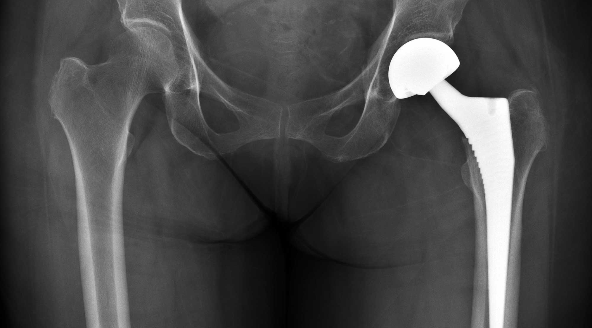 img-hip-replacement-3