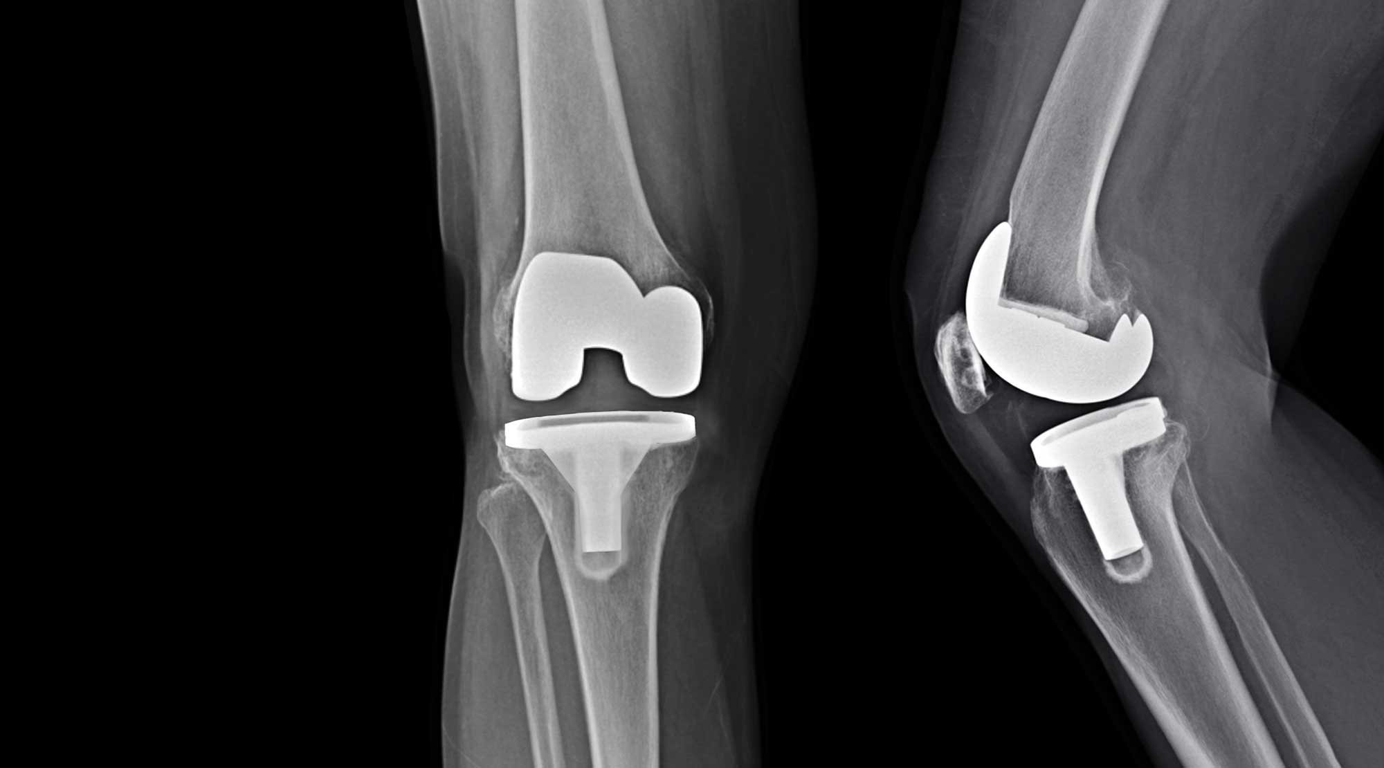 img-total-knee-replacement-2